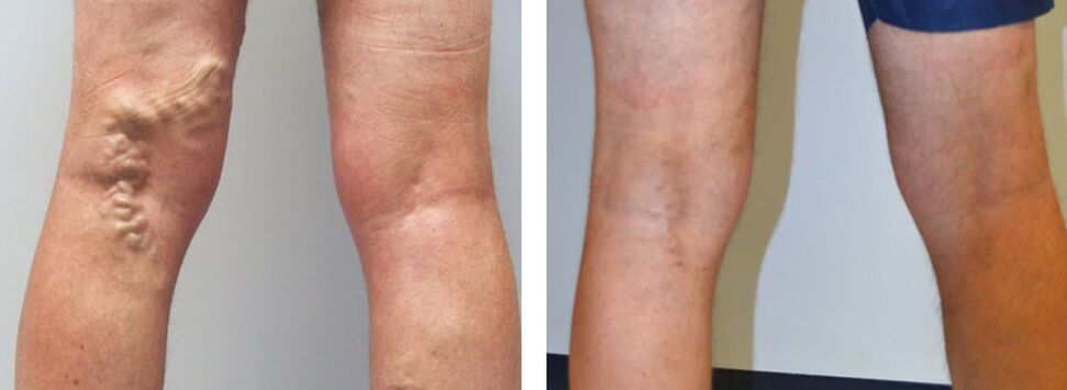 Foto před a po použití Veniselle, zážitek z používání krému