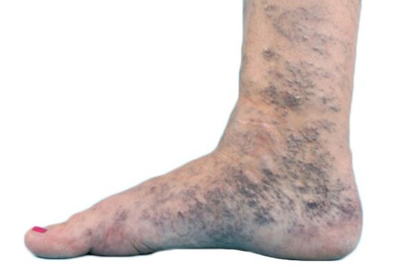 Krásné žíly na nohou