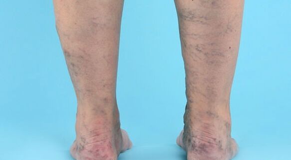 Onemocnění křečí