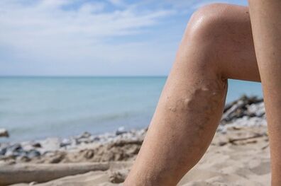 Kranní žíly na nohou