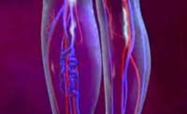 Příčiny a léčba křečových žil