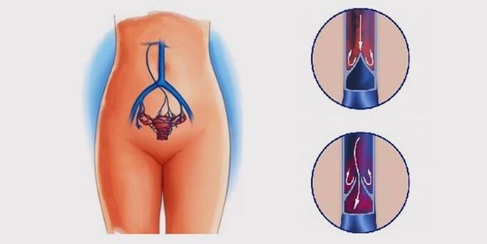 Křečové žíly pánve