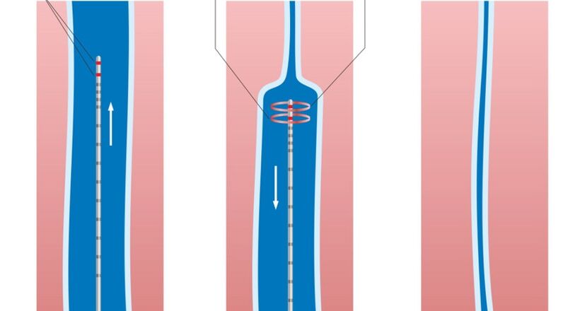 laserové ošetření křečových žil na nohou