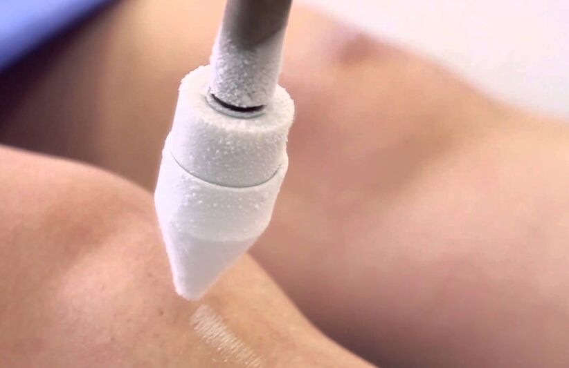 léčba křečových žil na nohou kryoterapií