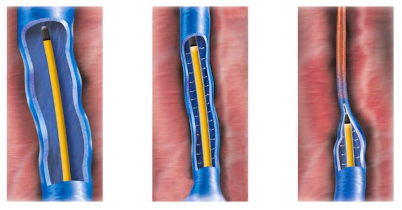 radiofrekvenční ablace jako metoda léčby křečových žil