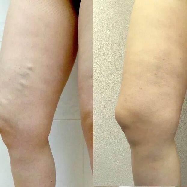 před a po léčbě křečových žil
